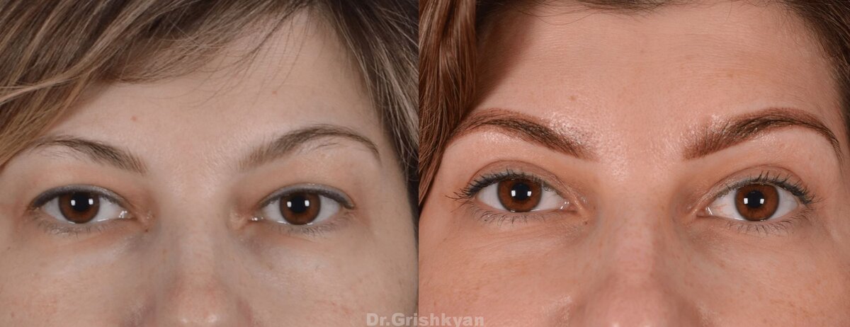 Блефаропластика верхних век фото до и после. Фото с сайта Д.Р. Гришкяна. Имеются противопоказания, требуется консультация специалиста
