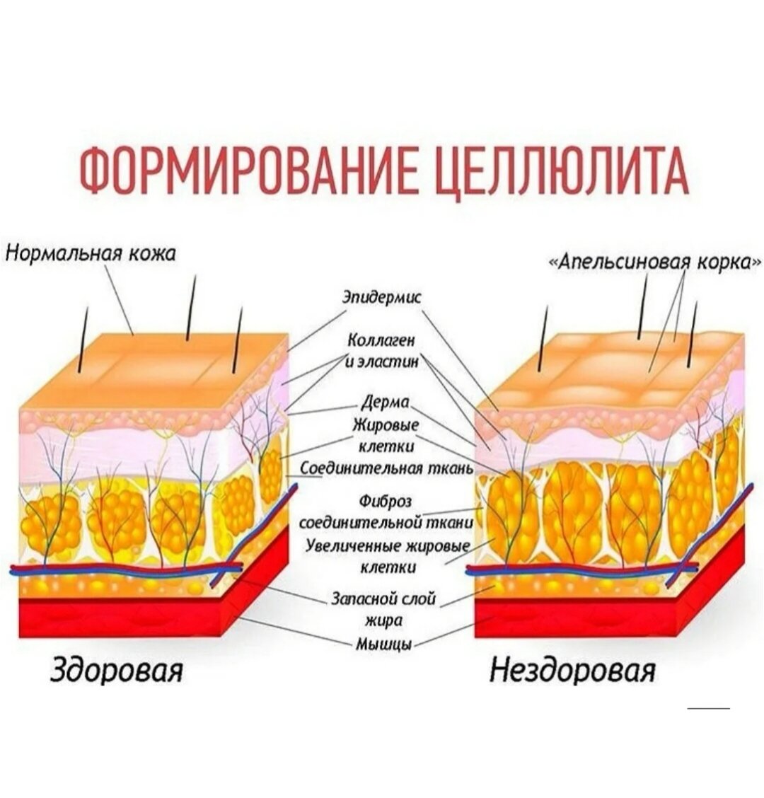 целлюлит груди у мужчин фото 110