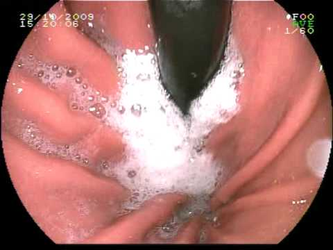 Пена в желудке (желудок без подготовки)