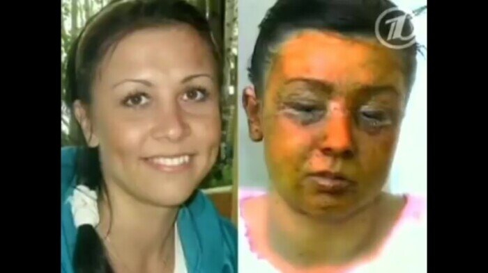 Татьяна Польская до и после произошедшей с ней трагедии.  Впервые ее фото было размещено в программе "Пусть говорят. Хью Грант и ревность"