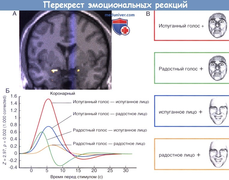 Перекрест эмоциональных реакций. (А) Структурная МРТ в коронарной проекции, на которую наложено изображения ПЭТ. Двусторонняя активация миндалевидного тела, которому представлено испуганное лицо с испуганным голосом (см. С). При представлении радостного лица и радостного голоса активность миндалевидного тела была минимальной. (Б) На графиках показана выраженность активности миндалевидного тела по данным фМРТ Источник: https://meduniver.com/Medical/Neurology/mindalevidnoe_telo_mozga.html MedUniver