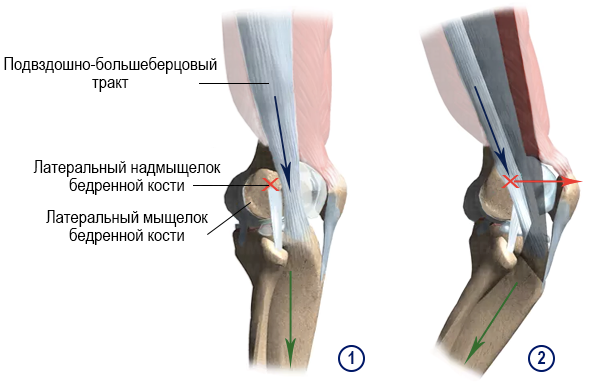 Синдром подвздошно большеберцового тракта. Синдром подвздошно большеберцового тракта. Синдром илиотибиального тракта. Синдром подвздошно большеберцового тракта. Большеберцовый тракт анатомия.
