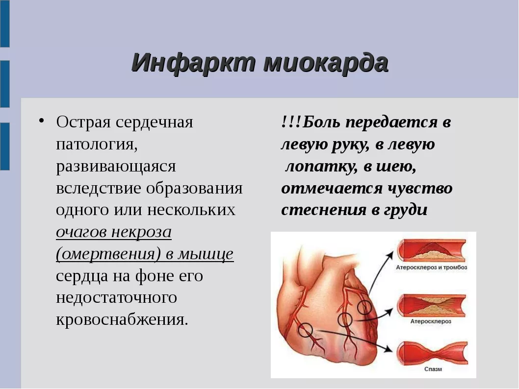 Инфаркт миокарда: почему он возникает, как проявляется и чем его лечат в  клинике | О здоровье: с медицинского на русский | Дзен