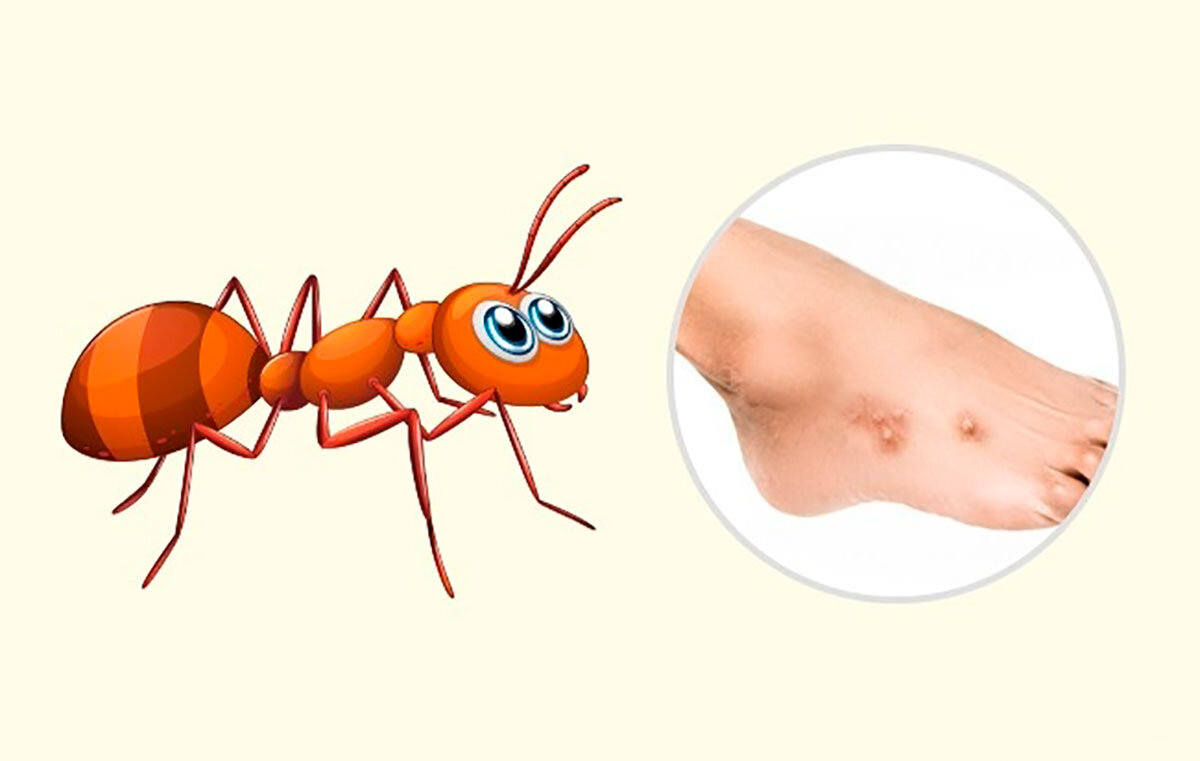 Как выглядит укус муравья 10 видов укусов насекомых - которые важно уметь различать Мед Блог Дзен