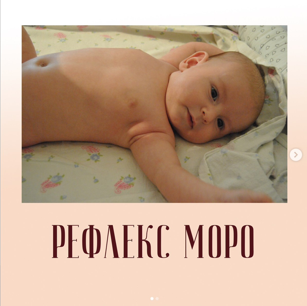 Рефлекс Моро. Рефлекс Моро у новорожденных. Рефлексы Моро у новорожденного.