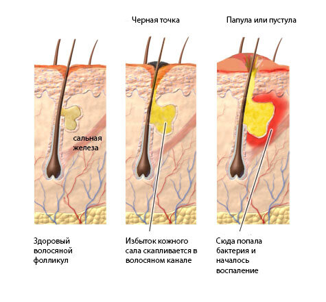 Иногда в сальную пробку попадает бактерия Propionibacterium acnes (p.acne), и развивается воспалительный процесс