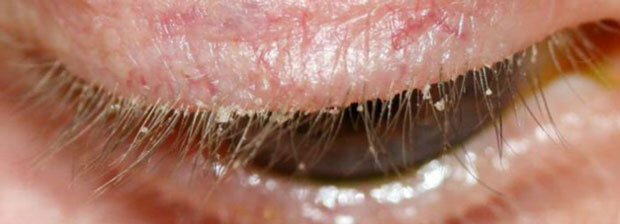 Хронический паразитарный блефарит - наиболее частая причина рецидивирующих ячменей и халязионов век.