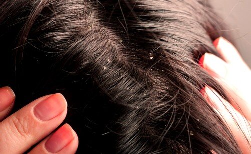 Как  распознать, что присутствует пересохшая кожа головы, а не перхоть? Оба состояния часто путают из-за симптомов. Прежде всего, замечены хлопья от кожи головы. Кожа может зудеть. Лепестки беловатые или желтоватые. Чтобы быть уверенным, что проблема не в перхоти, вы должны начать со специального шампуня против перхоти. Если применение в соответствии с рекомендациями не дает никаких эффектов, это признак того, что причиной постоянного зуда и появления сухих хлопьев может быть пересушенная кожа головы .