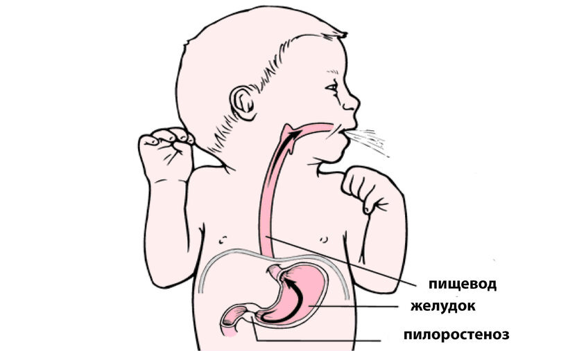 Процессы ЖКТ при пилоростенозе