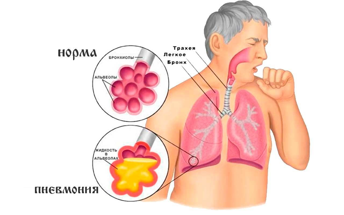 4 причины, провоцирующие пневмонию: далеко не всегда причина – в инфекции |  О здоровье: с медицинского на русский | Дзен