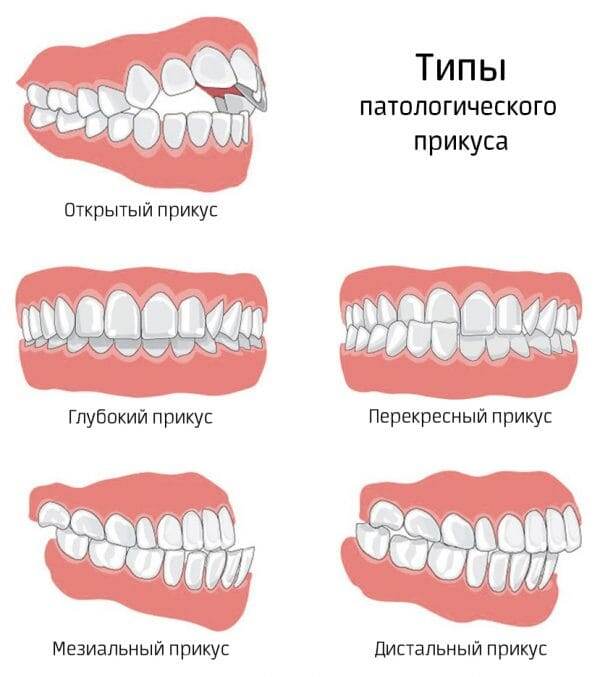 Полная замена молочных зубов на постоянные зубы. Сроки, особенности.