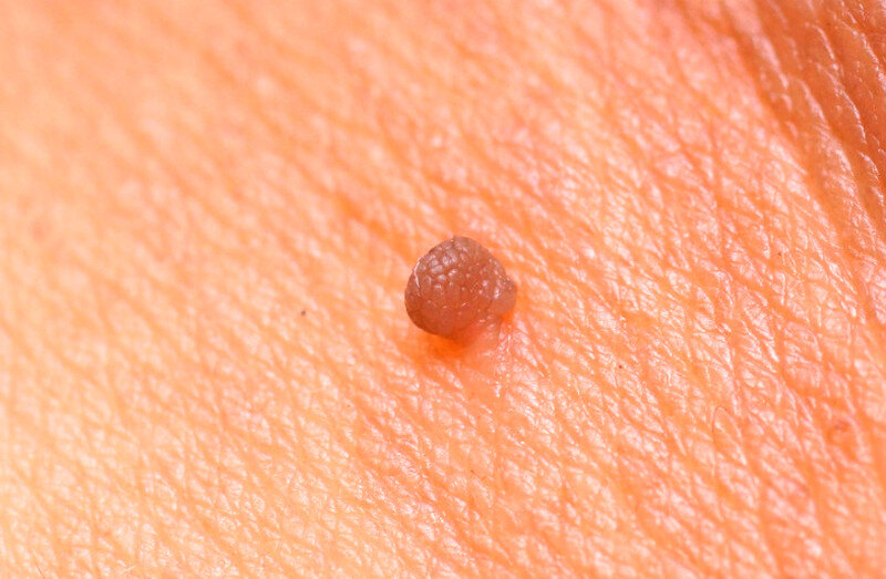 Is it dangerous to remove papillomas at home? The consequences of wart removal do it yourself