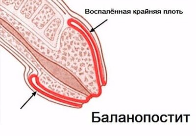 Схематично: что именно воспаляется при баланопостите