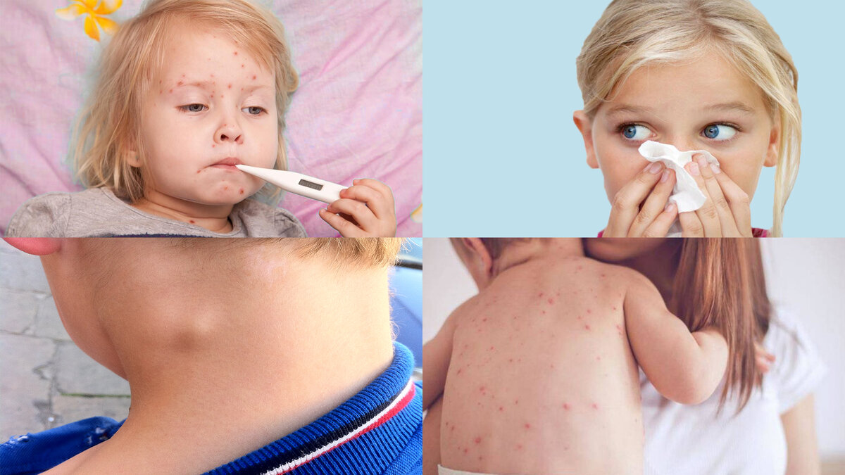 Как и ветрянку, дети краснуху переносят легче, чем взрослые.
