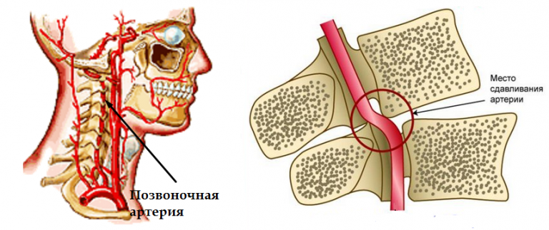Артерии шейного отдела позвоночника. Сдавление позвоночной артерии. Синдром малой позвоночной артерии. Сдавление позвоночной артерии шейного отдела. Синдром сдавливания позвоночной артерии.