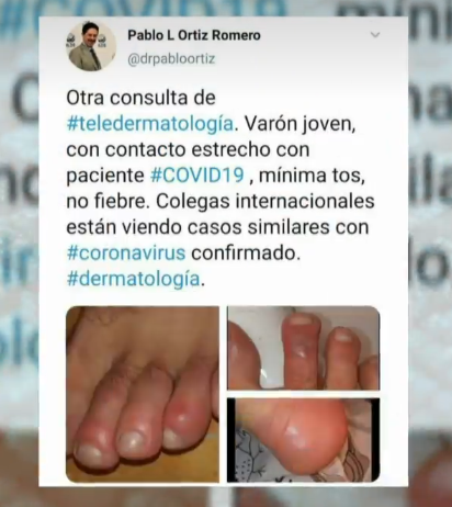 Источник Twitter аккаунт Дерматолога Pablo L Ortiz Romero https://twitter.com/drpabloortiz