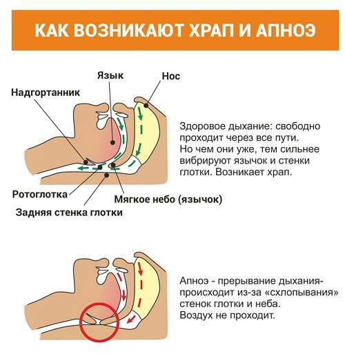 Почему беременные храпят и когда нужно беспокоиться?