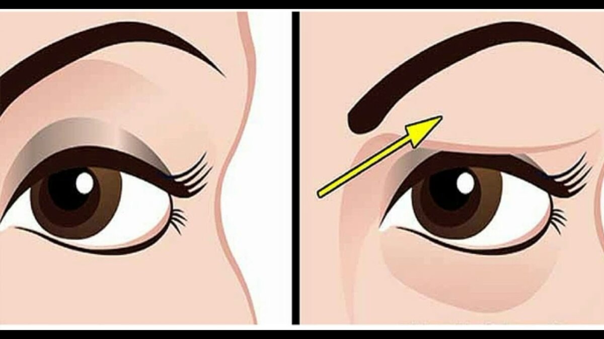 Тяжелое веко определить очень просто. Расслабляем глаза и смотрим прямо перед собой: если не видно или практически не видно подвижного века - нависание есть. justwoman.club