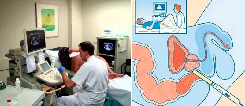 Проведение исследования простаты   - УЗИ