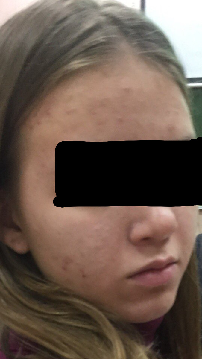 Моя кожа до появления правильного ухода 