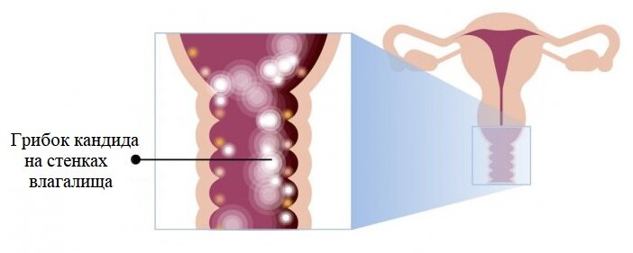 Молочница - это не страшно! Фото: Яндекс Картинки