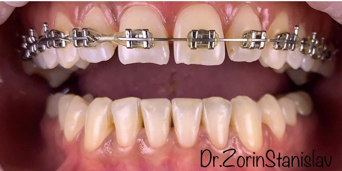 Фото пациента  во время лечения у ортодонта  в стоматологической клинике "Имплант Эксперт" 