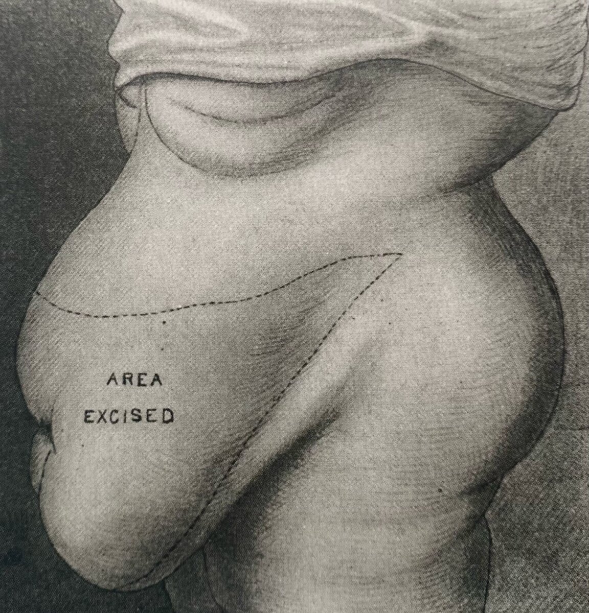 15 мая 1899г. Говард А. Келли из Балтимора сделал первую операцию по подтяжке живота