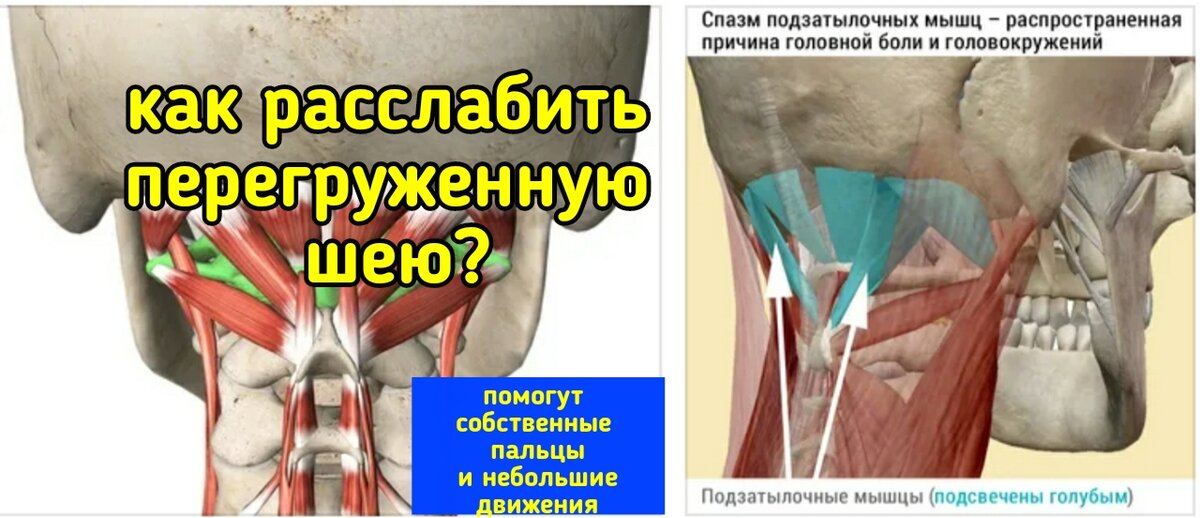 Перенапряжение мышц симптомы. Короткие разгибатели шеи. Спастическое сокращение мышц. Перенапряжение мышц. Перенапряжение шейных мышц.