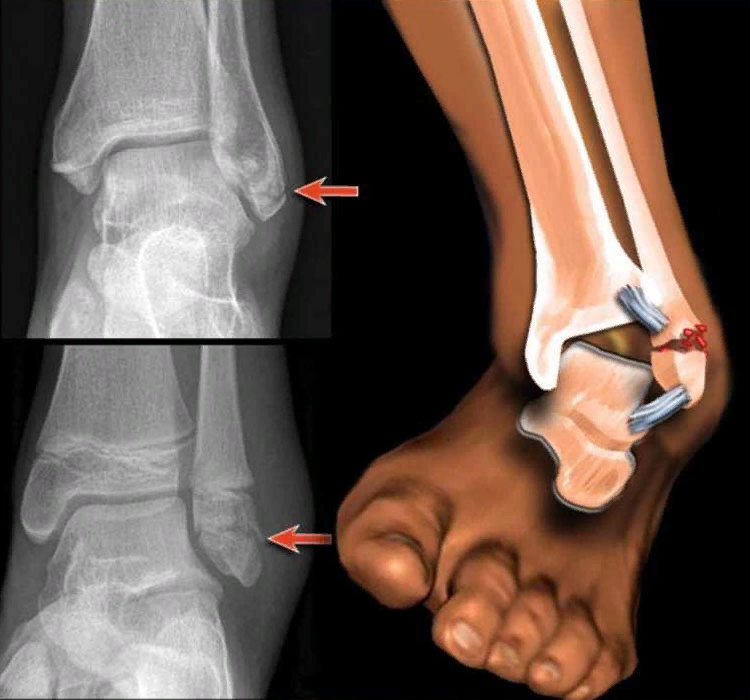Трещина в голени. Перелом латеральной лодыжки. Супинационно аддукционный перелом лодыжек. Перелом наружной лодыжки рентген. Перелом наружной лодыжки большеберцовой кости.