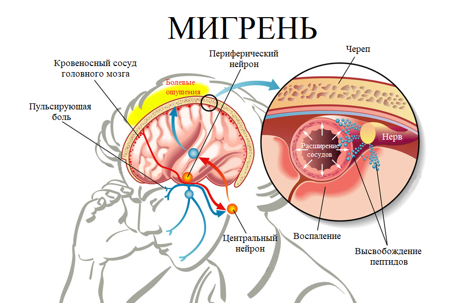 Мигрень возникает из-за асептического воспаления в системе тройничного нерва