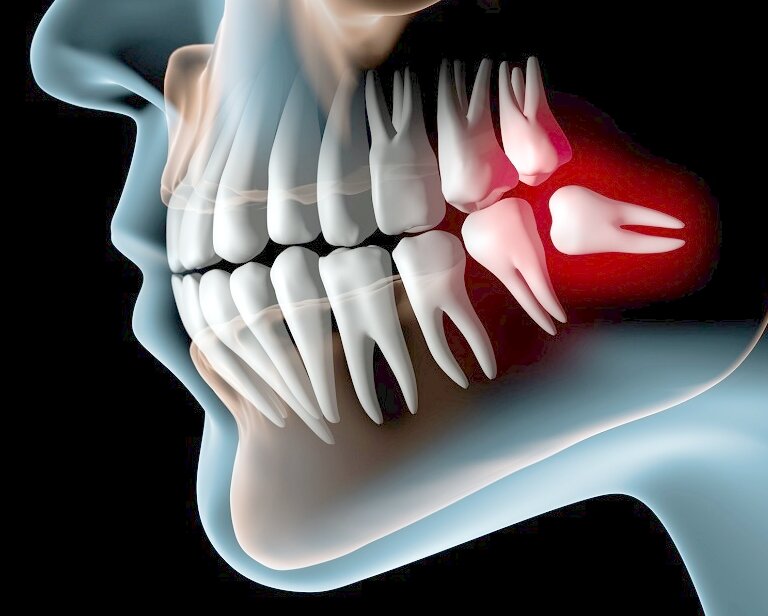 Восьмёрки, зубы мудрости, третьи моляры.