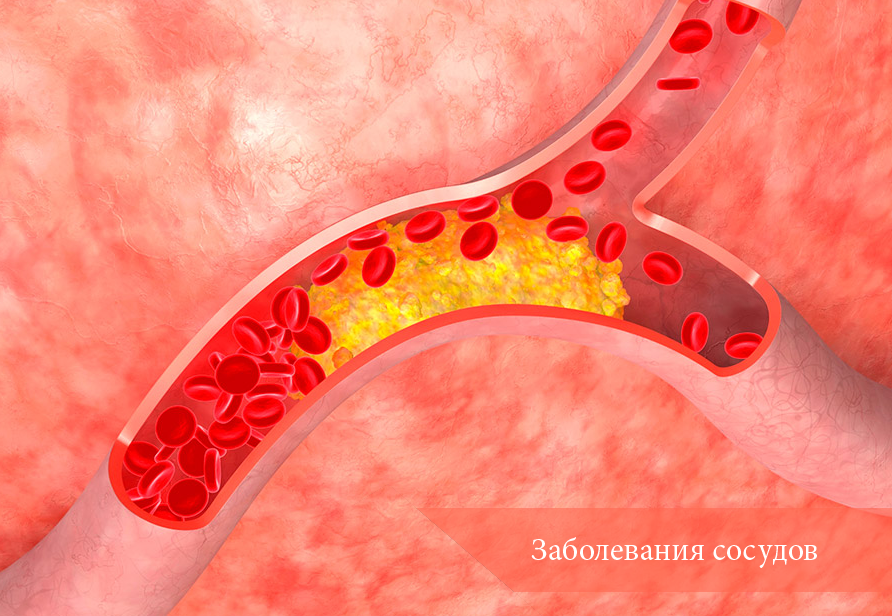 Атеросклероз сосудов головного мозга
