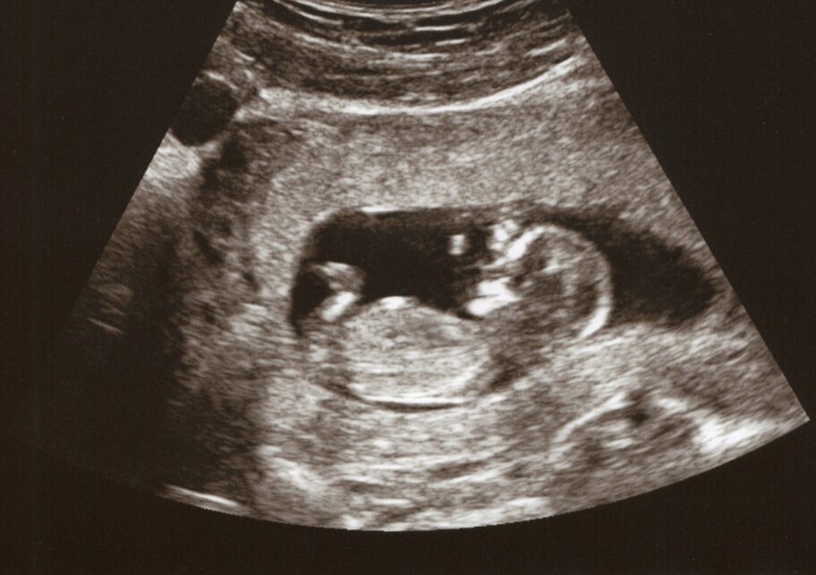12 недель видео. Снимок ребенка на УЗИ 12 недель беременности. УЗИ плод девочка 12 недель беременности. Снимок УЗИ на 12 неделе беременности. УЗИ 12 недель беременности фото.