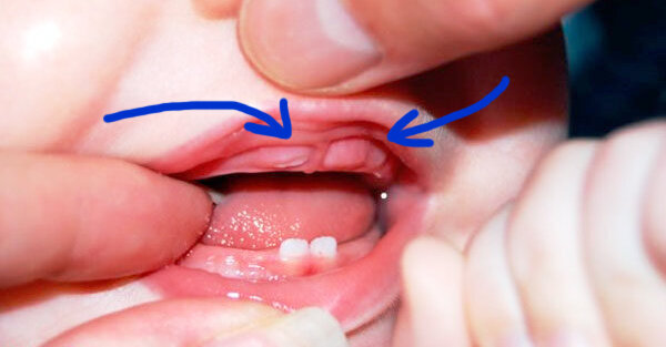 Прорезывание молочных зубов. Симптомы. Что делать.