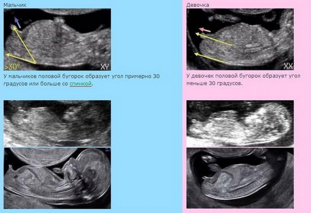 УЗИ при беременности в 3D- и 4D режимах, особенности и возможности