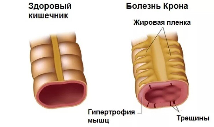 Болезнь Крона: причины и современные способы лечения