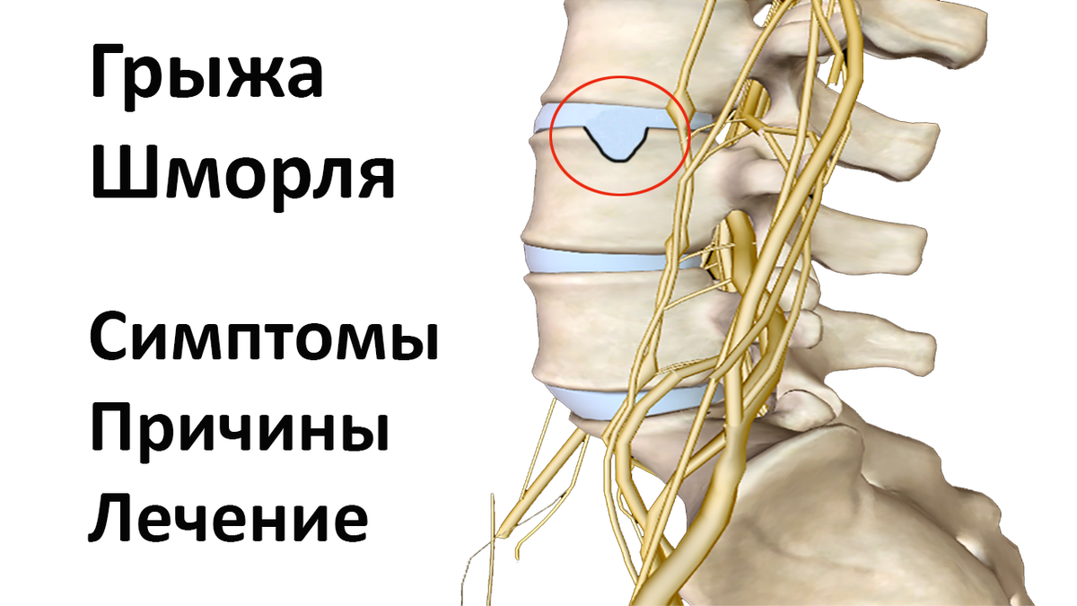 Грыжа Шморля в красном кружочке