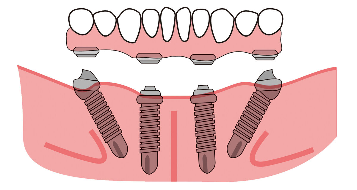 Все на 4 имплантах картинки