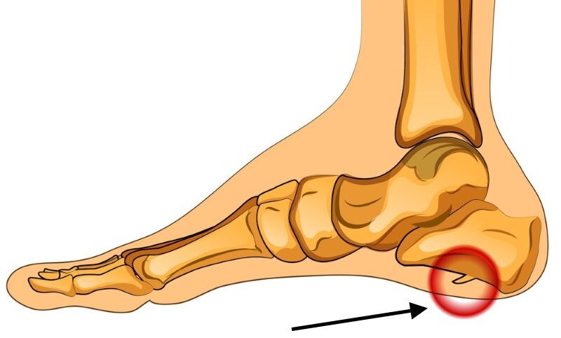 Пяточная шпора — что это и существует ли эффективное лечение?