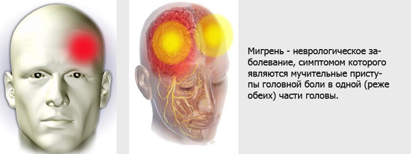 Мигрень клиническая картина