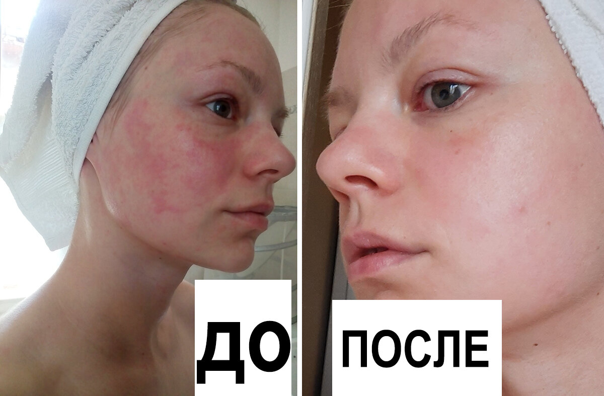 Фото сняты на два разных телефона. На фото ДО очень легкий вариант того, каким бывало мое лицо после душа. А на фото ПОСЛЕ, телефон немного замылил текстуру кожи, но тем не менее это не мешает нам увидеть, что покраснений практически нет.