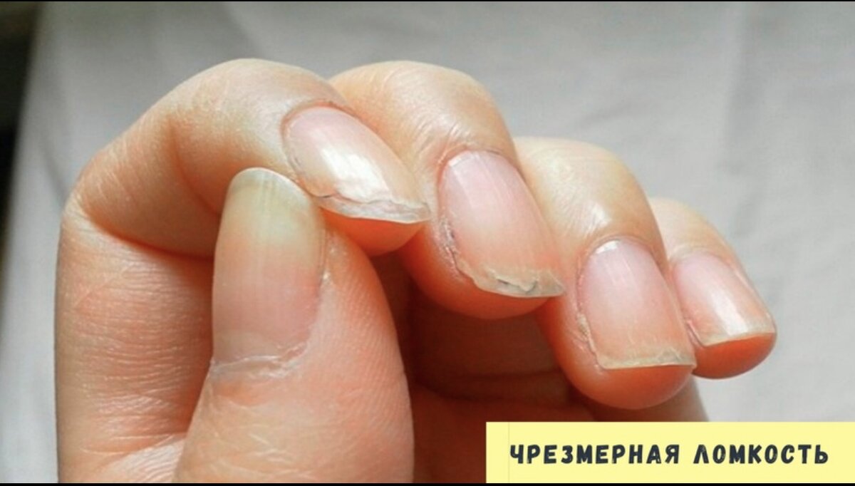 Чрезмерная ломкость 