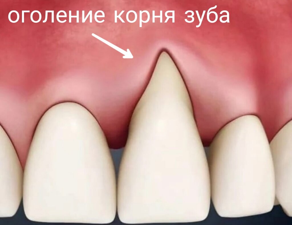 Оголился зуб фото