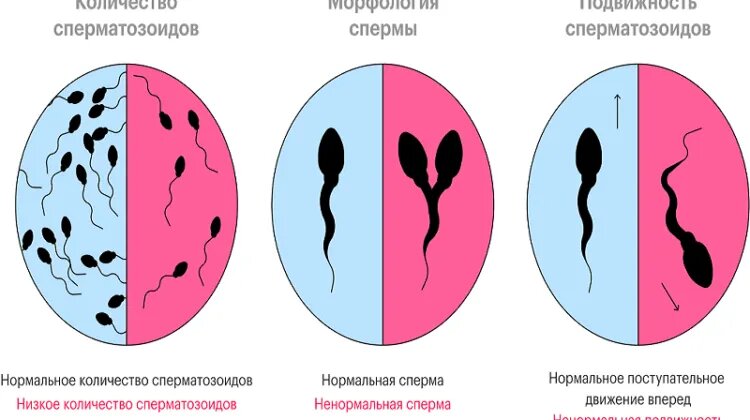 Акинозооспермия: причины, диагностика и лечение. Неподвижность сперматозоидов.