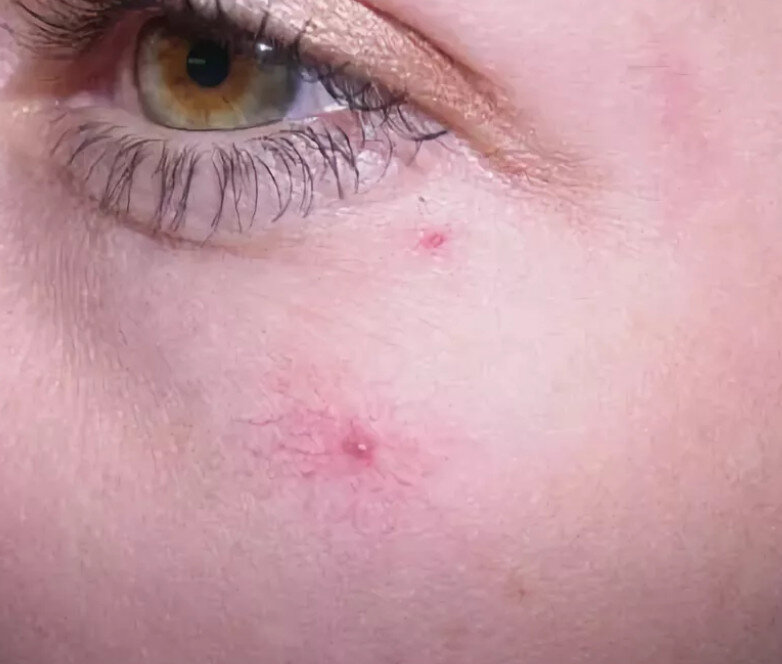 телеангиэктазии