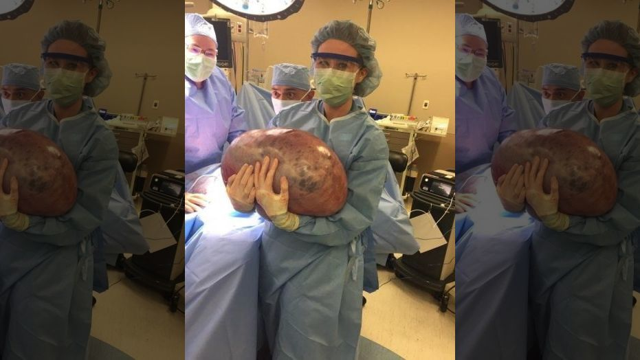 Киста весом 22 килограмма