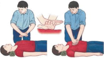 Непрямой массаж сердца