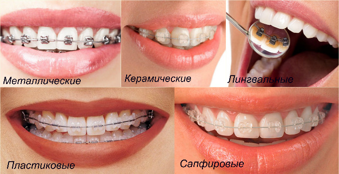 Виды брекетов