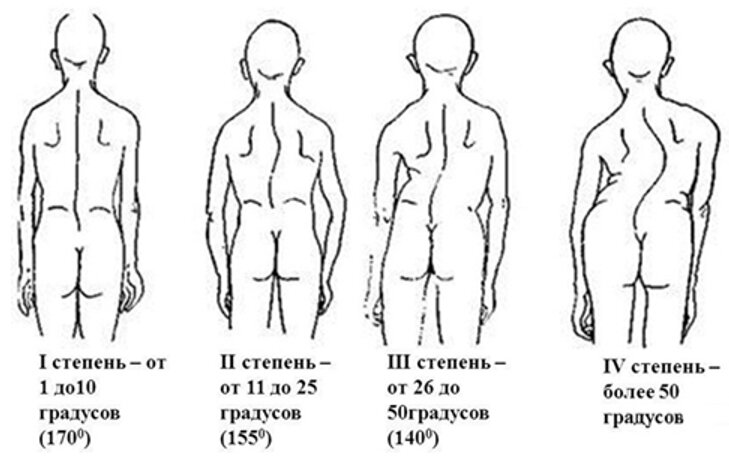 Лечение сколиоза у взрослых