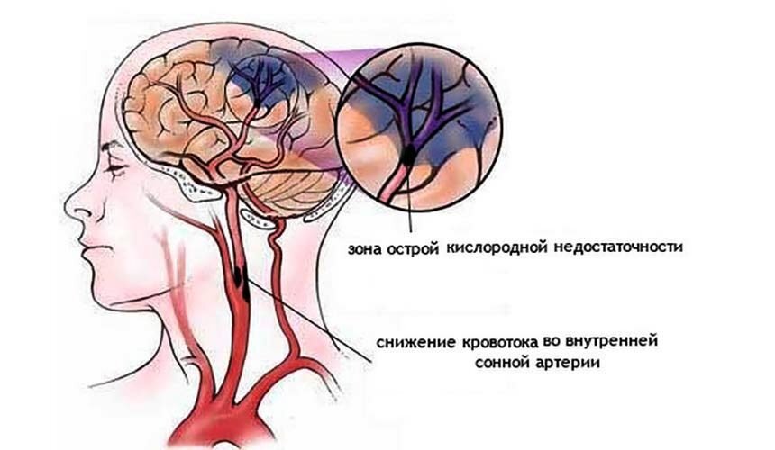 Как лечить нарушение мозгового кровообращения